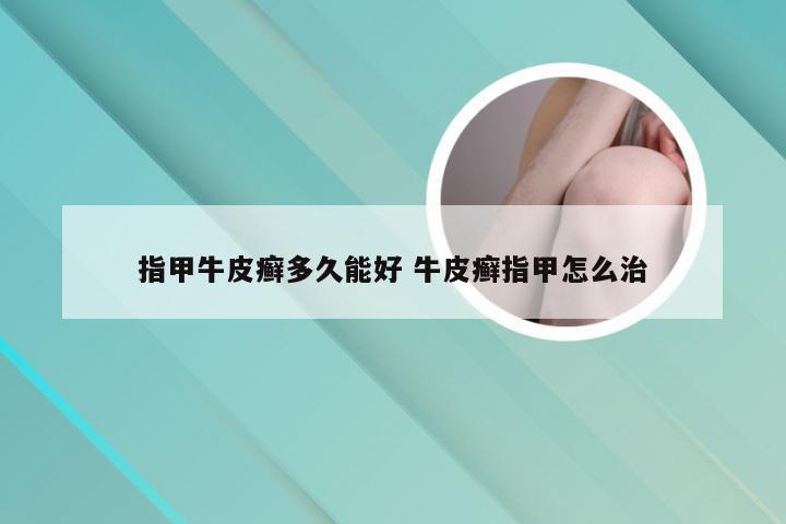 指甲牛皮癣多久能好 牛皮癣指甲怎么治