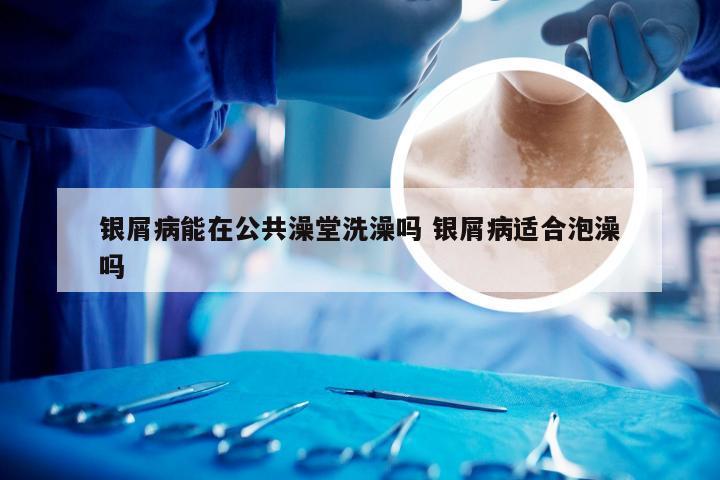 银屑病能在公共澡堂洗澡吗 银屑病适合泡澡吗