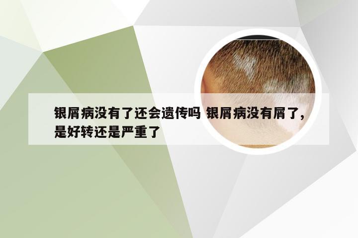 银屑病没有了还会遗传吗 银屑病没有屑了,是好转还是严重了