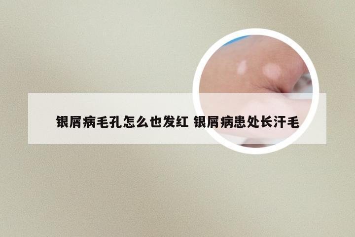 银屑病毛孔怎么也发红 银屑病患处长汗毛