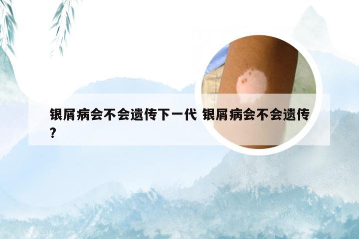 银屑病会不会遗传下一代 银屑病会不会遗传?