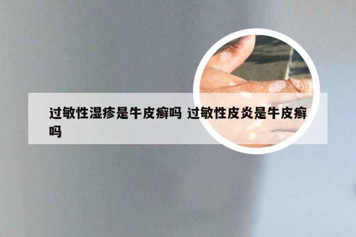 过敏性湿疹是牛皮癣吗 过敏性皮炎是牛皮癣吗