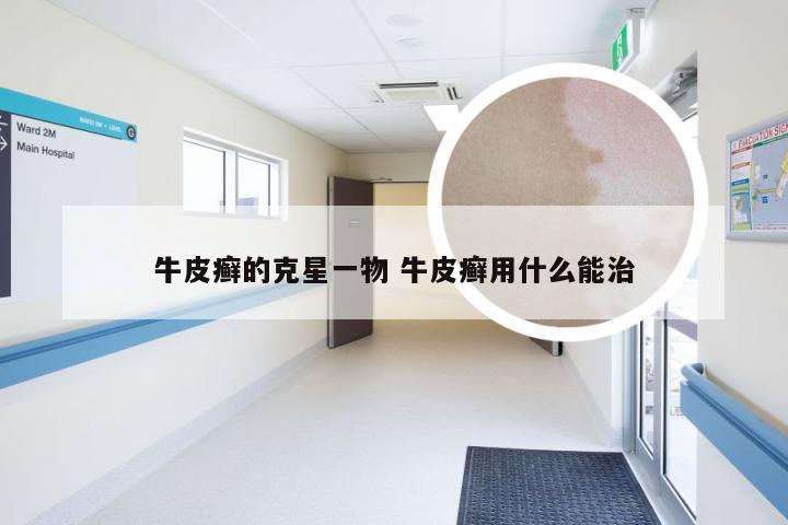牛皮癣的克星一物 牛皮癣用什么能治