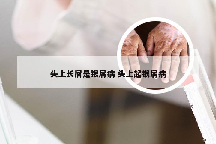 头上长屑是银屑病 头上起银屑病