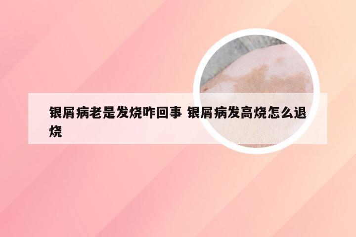 银屑病老是发烧咋回事 银屑病发高烧怎么退烧