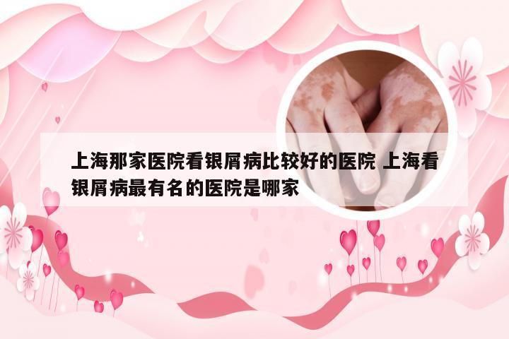 上海那家医院看银屑病比较好的医院 上海看银屑病最有名的医院是哪家