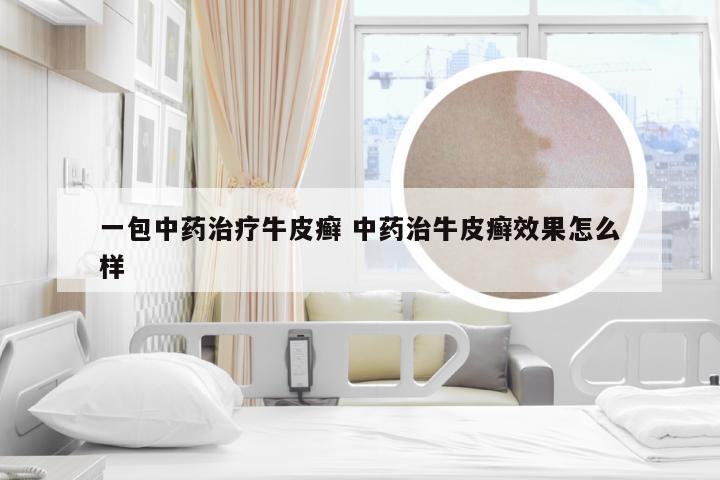 一包中药治疗牛皮癣 中药治牛皮癣效果怎么样