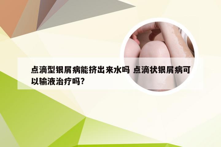 点滴型银屑病能挤出来水吗 点滴状银屑病可以输液治疗吗?