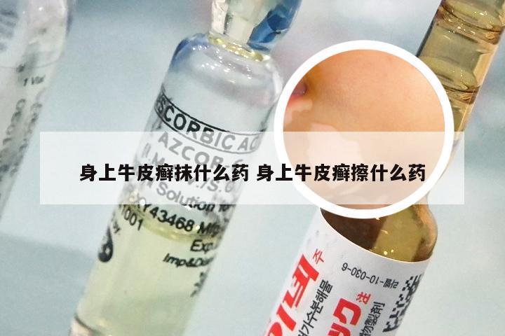 身上牛皮癣抹什么药 身上牛皮癣擦什么药