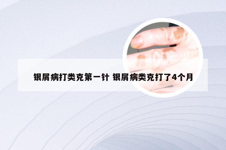 银屑病打类克第一针 银屑病类克打了4个月