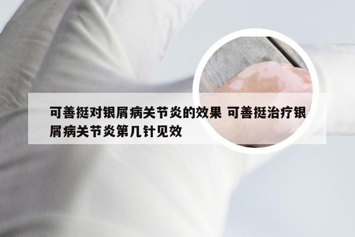 可善挺对银屑病关节炎的效果 可善挺治疗银屑病关节炎第几针见效