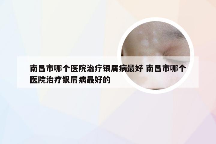 南昌市哪个医院治疗银屑病最好 南昌市哪个医院治疗银屑病最好的