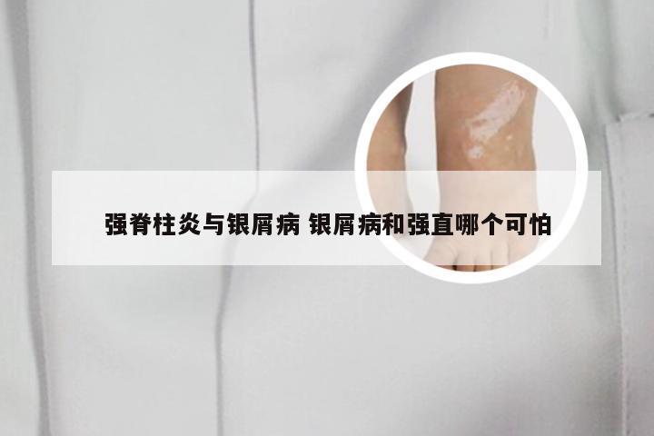 强脊柱炎与银屑病 银屑病和强直哪个可怕