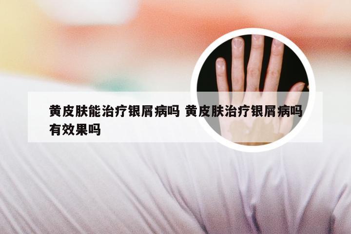 黄皮肤能治疗银屑病吗 黄皮肤治疗银屑病吗有效果吗