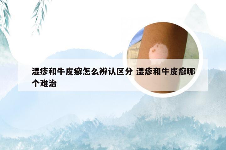 湿疹和牛皮癣怎么辨认区分 湿疹和牛皮癣哪个难治