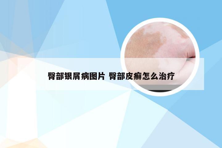 臀部银屑病图片 臀部皮癣怎么治疗