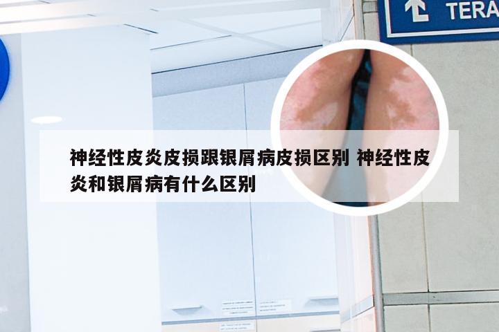 神经性皮炎皮损跟银屑病皮损区别 神经性皮炎和银屑病有什么区别