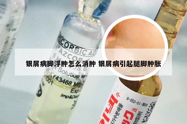 银屑病脚浮肿怎么消肿 银屑病引起腿脚肿胀