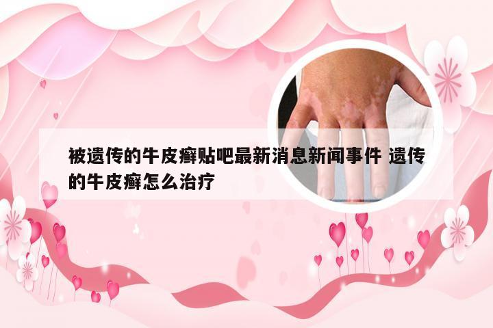 被遗传的牛皮癣贴吧最新消息新闻事件 遗传的牛皮癣怎么治疗