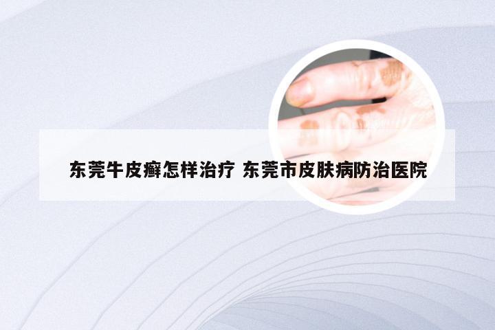 东莞牛皮癣怎样治疗 东莞市皮肤病防治医院