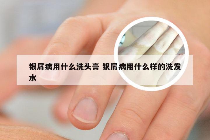 银屑病用什么洗头膏 银屑病用什么样的洗发水