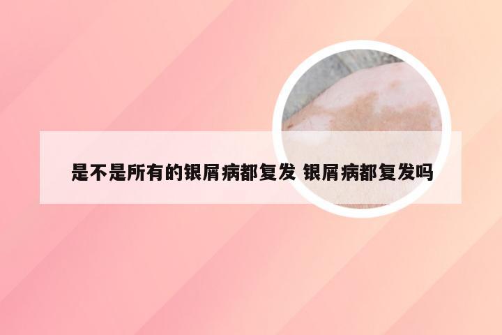 是不是所有的银屑病都复发 银屑病都复发吗