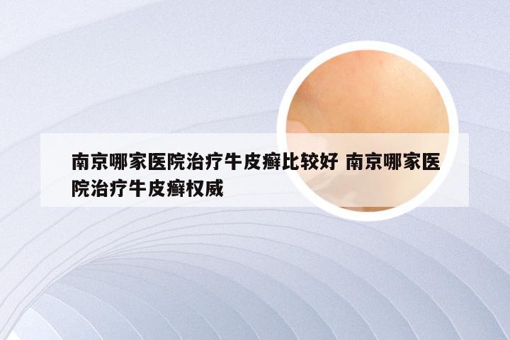 南京哪家医院治疗牛皮癣比较好 南京哪家医院治疗牛皮癣权威