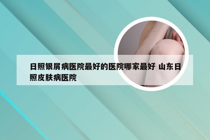 日照银屑病医院最好的医院哪家最好 山东日照皮肤病医院