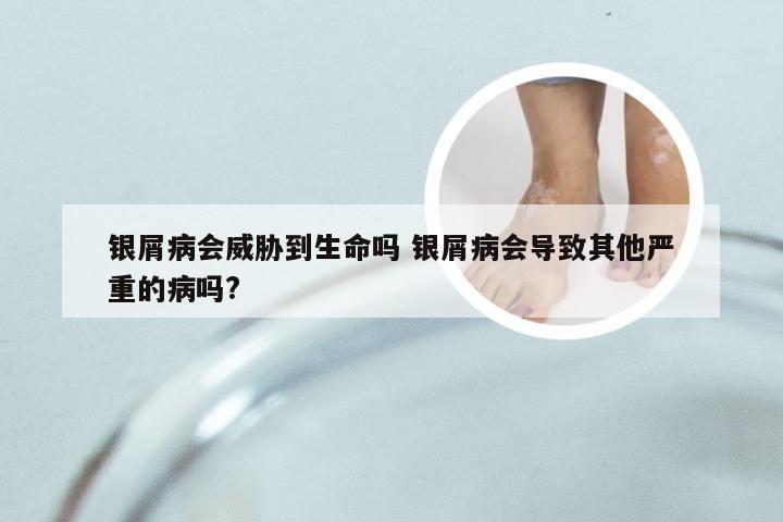 银屑病会威胁到生命吗 银屑病会导致其他严重的病吗?