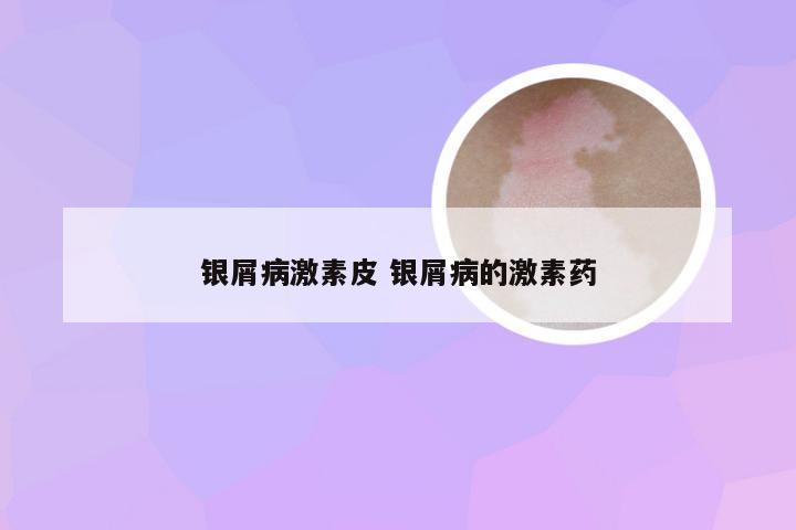 银屑病激素皮 银屑病的激素药