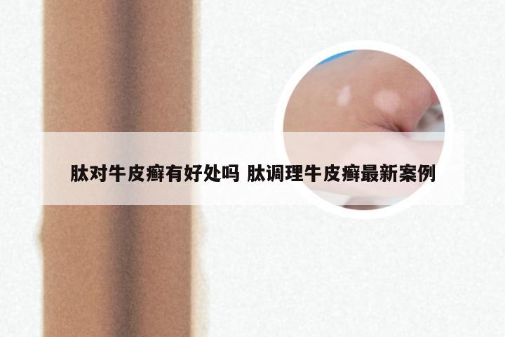 肽对牛皮癣有好处吗 肽调理牛皮癣最新案例