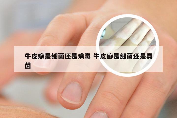 牛皮癣是细菌还是病毒 牛皮癣是细菌还是真菌