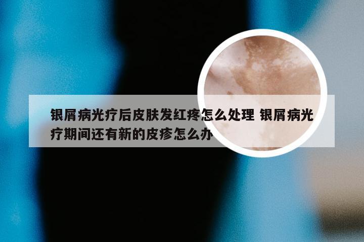银屑病光疗后皮肤发红疼怎么处理 银屑病光疗期间还有新的皮疹怎么办