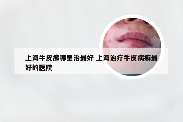 上海牛皮癣哪里治最好 上海治疗牛皮病癣最好的医院