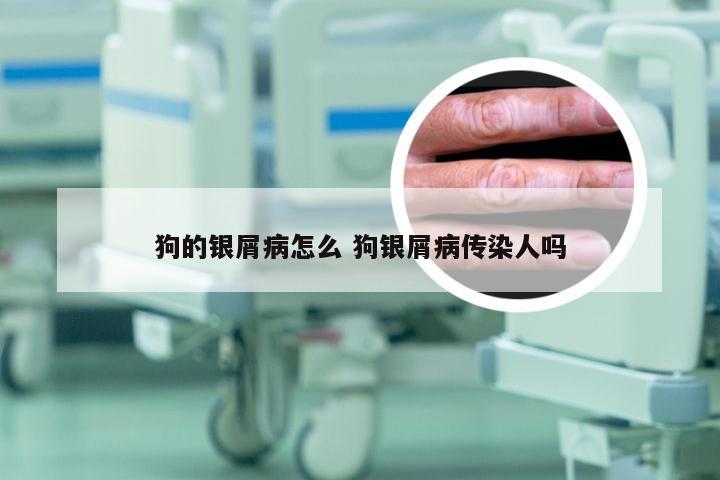 狗的银屑病怎么 狗银屑病传染人吗