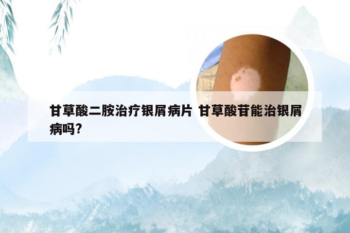 甘草酸二胺治疗银屑病片 甘草酸苷能治银屑病吗?