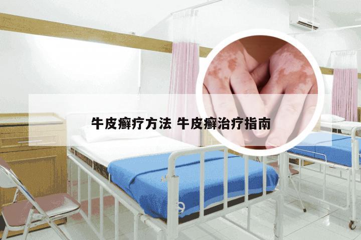 牛皮癣疗方法 牛皮癣治疗指南