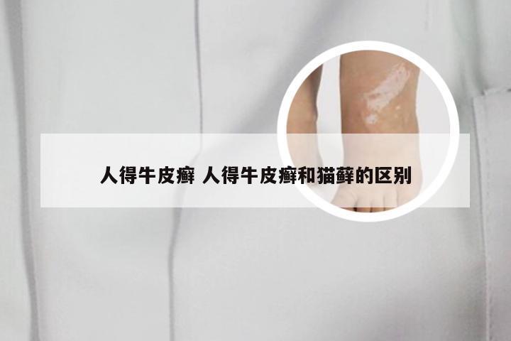 人得牛皮癣 人得牛皮癣和猫藓的区别