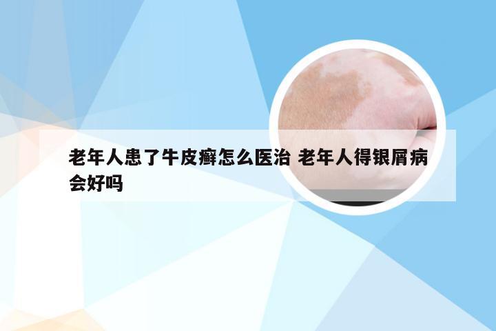 老年人患了牛皮癣怎么医治 老年人得银屑病会好吗