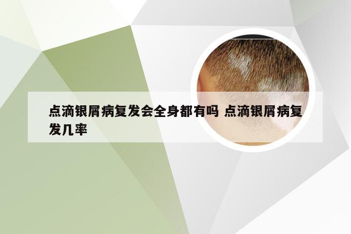 点滴银屑病复发会全身都有吗 点滴银屑病复发几率