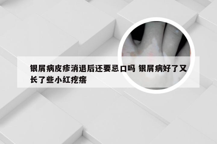 银屑病皮疹消退后还要忌口吗 银屑病好了又长了些小红疙瘩