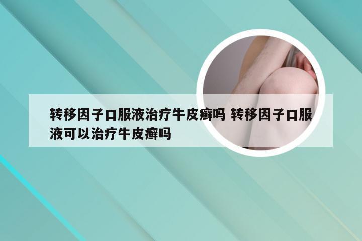 转移因子口服液治疗牛皮癣吗 转移因子口服液可以治疗牛皮癣吗