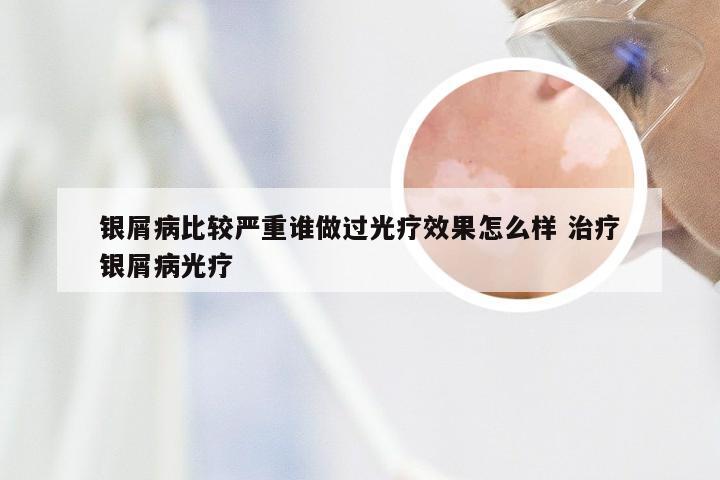 银屑病比较严重谁做过光疗效果怎么样 治疗银屑病光疗