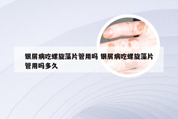 银屑病吃螺旋藻片管用吗 银屑病吃螺旋藻片管用吗多久