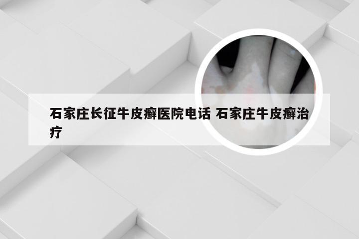 石家庄长征牛皮癣医院电话 石家庄牛皮癣治疗