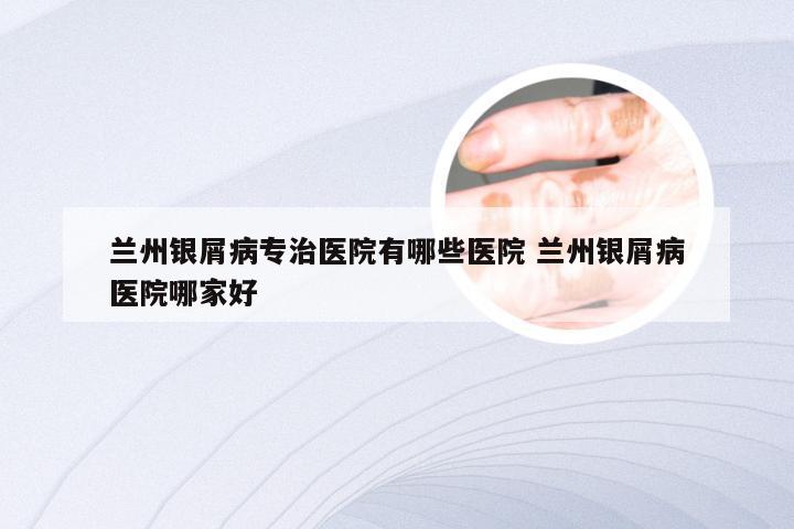 兰州银屑病专治医院有哪些医院 兰州银屑病医院哪家好