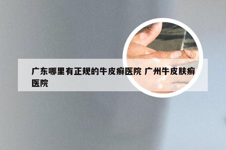 广东哪里有正规的牛皮癣医院 广州牛皮肤癣医院