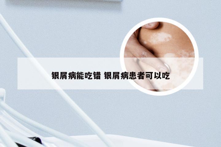 银屑病能吃错 银屑病患者可以吃