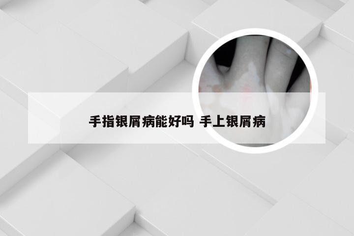 手指银屑病能好吗 手上银屑病