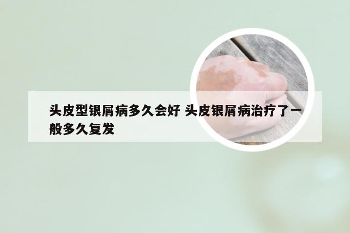 头皮型银屑病多久会好 头皮银屑病治疗了一般多久复发